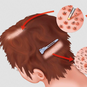 FUE Haartransplantationstechnik und Anwendung