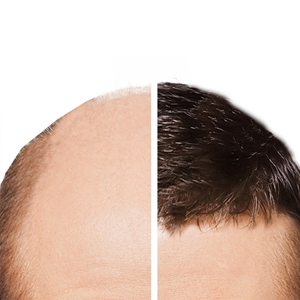 FUE Haartransplantationstechnik
